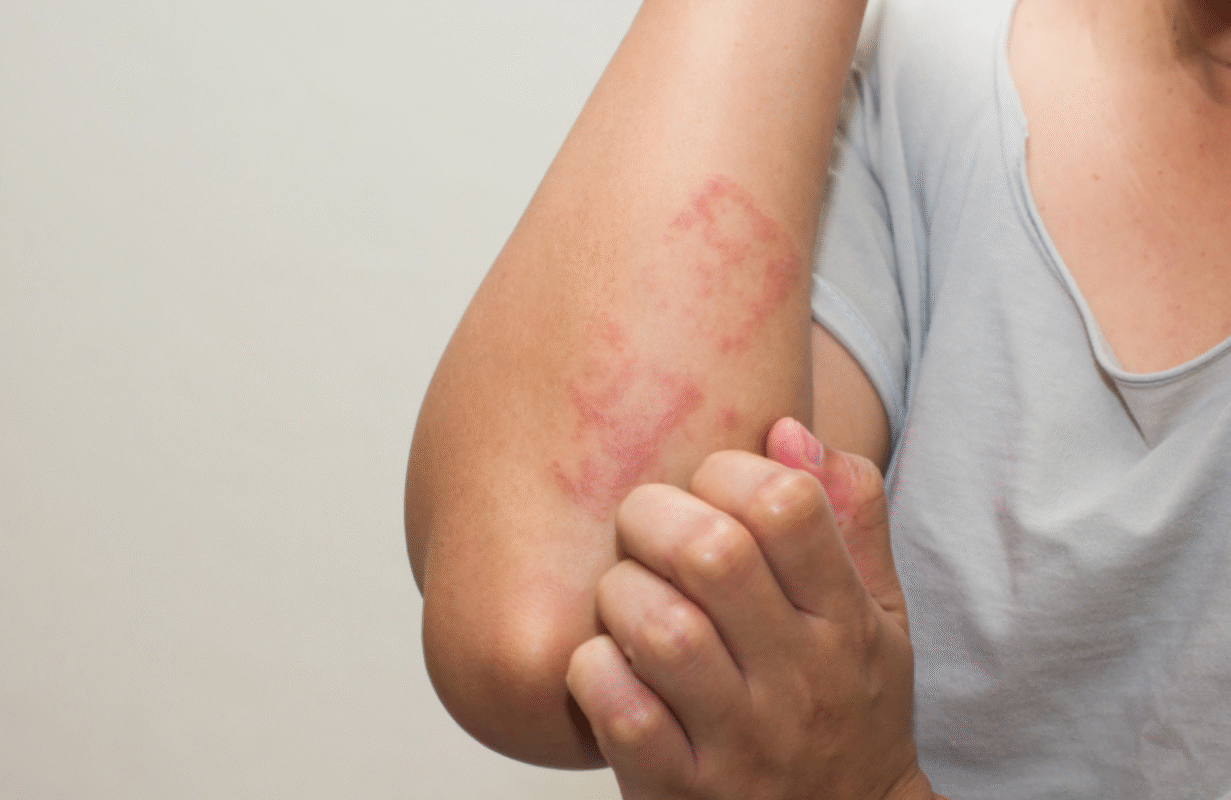 How to Take Ivermectin for Scabies?