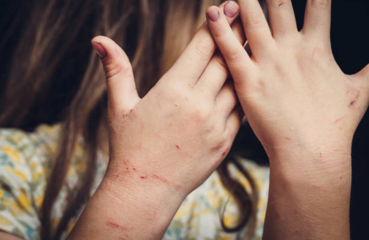 Get Rid of Scabies in 24 Hours
