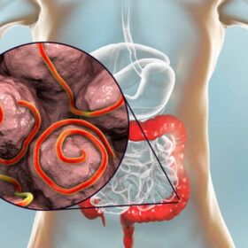 Symptoms of Worms in Humans