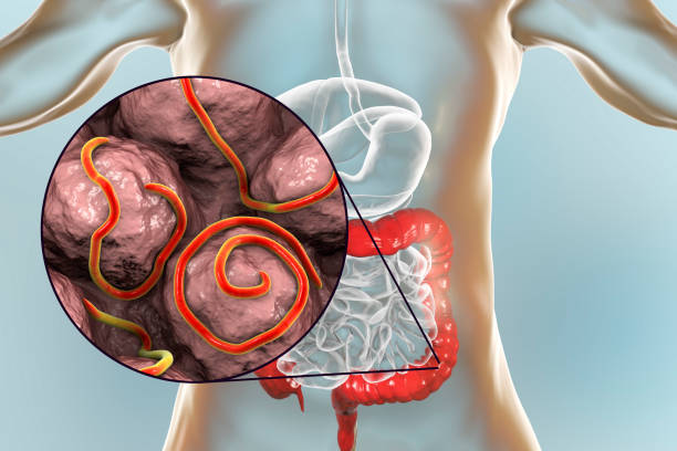 Symptoms of Worms in Humans